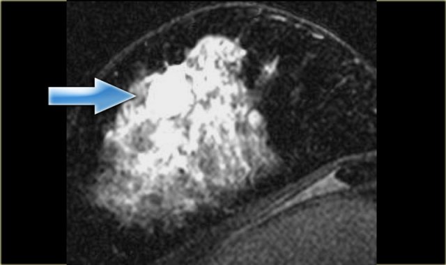 Colloid carcinoma