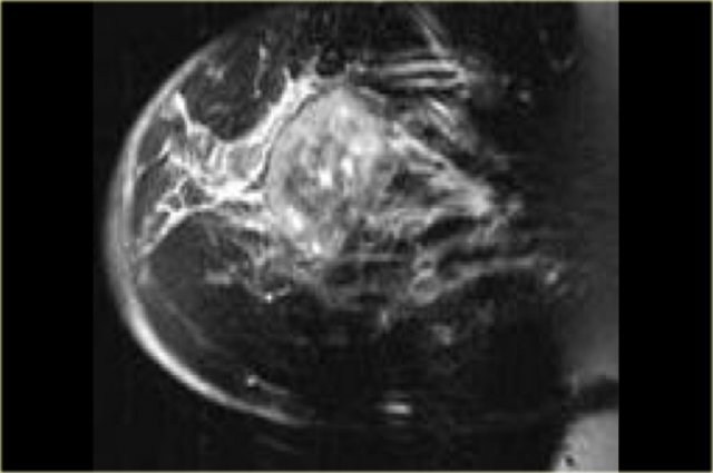 Sarcoma with osseous differentiation