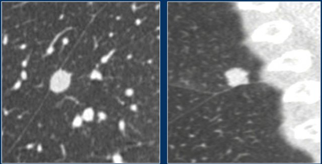 Non-PFN lesions. Courtesy of M. Prokop