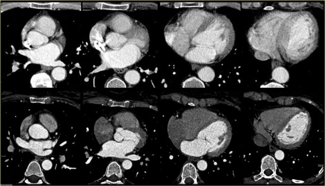 Axial slices through the heart