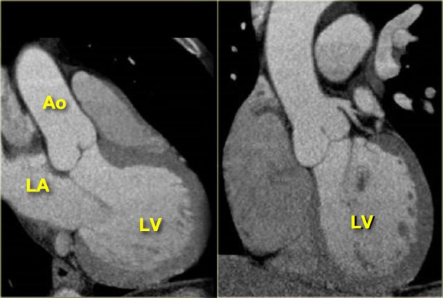 3-chamber (left) and coronal (right) reconstructions, same as above