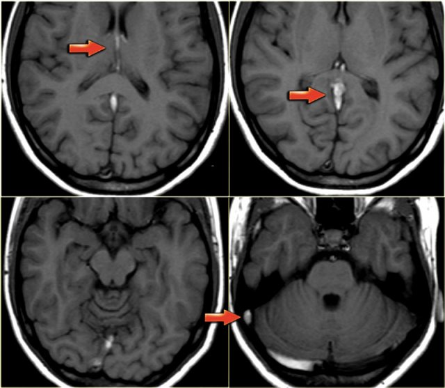 Venous thrombosis with absence of normal flow void on T1-weighted image.