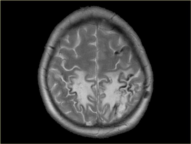 Bilateral infarction in superior sagittal sinus thrombosis