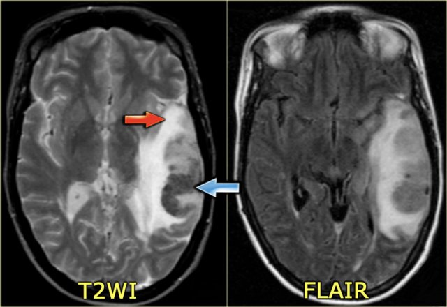 Hemorrhagic venous infarct in Labbe territory