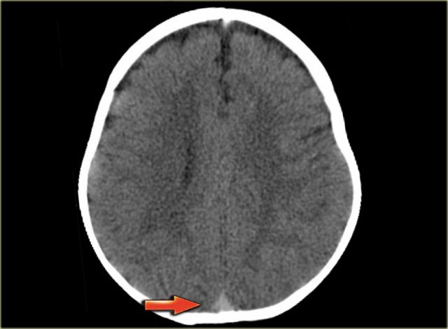 Mimick of dense clot sign in an infant