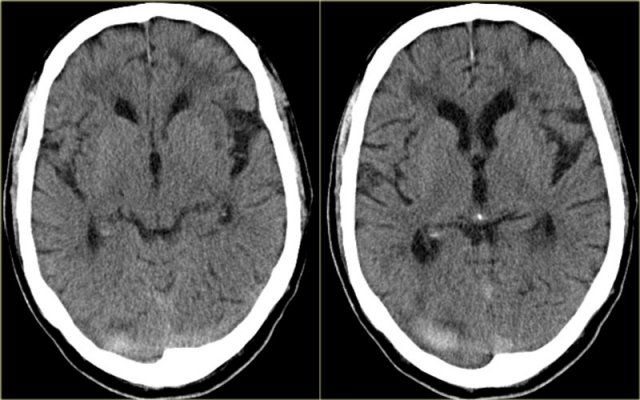 Hematoma mimicking a dense clot sign