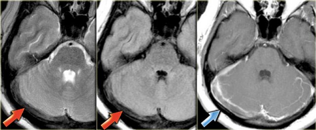 Thrombus in right transverse sinus is dark on T2 due to intracellular deoxyhemoglobin (Courtesy dr. Howard Rowley)