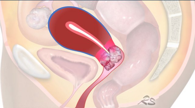 Cervical Cancer - MR staging