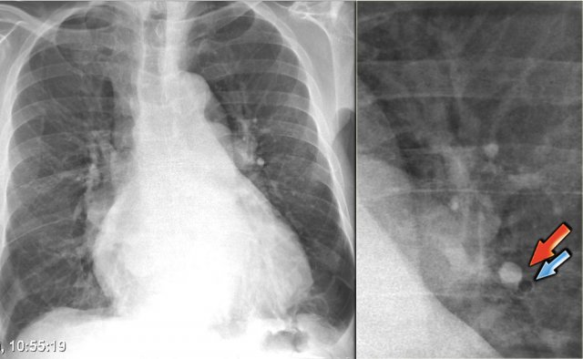 Increased artery-to-bronchus ratio in CHF