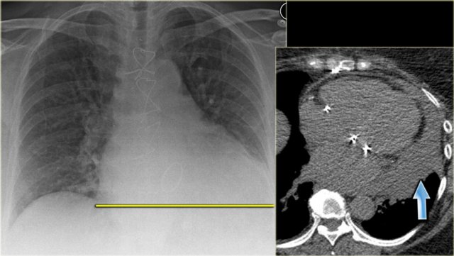 Increased CTR due to pericardial effusion