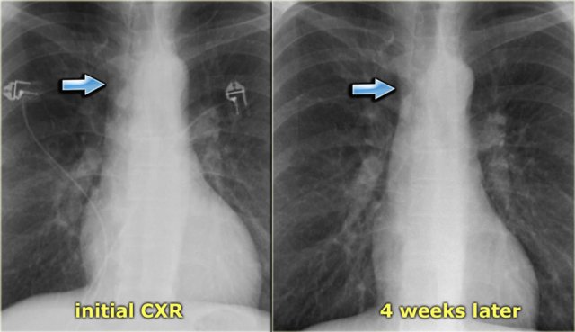 Subtle increased width of vascular pedicle (left) and normalisation (right)