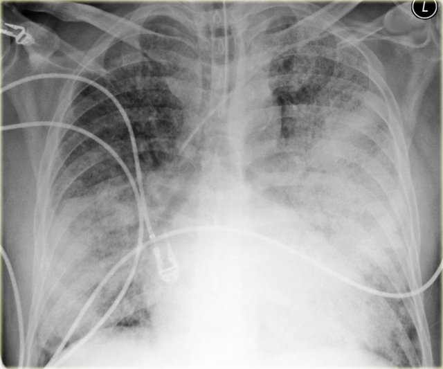 Bilateral legionella pneumonia