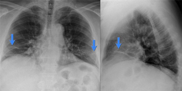 Plate-like atelectasis due to poor inspiration in a patient who had abdominal surgery