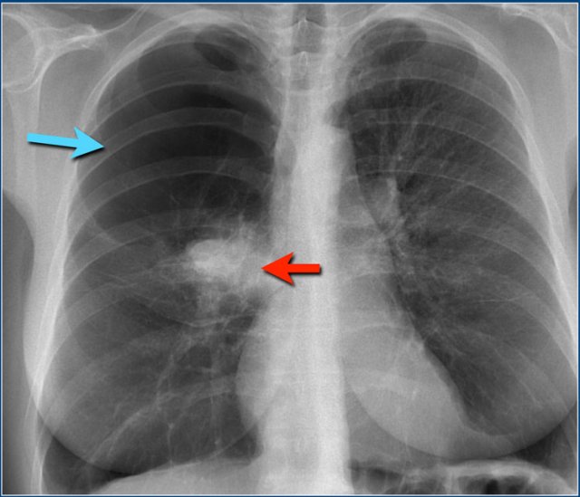 Bronchial atresia