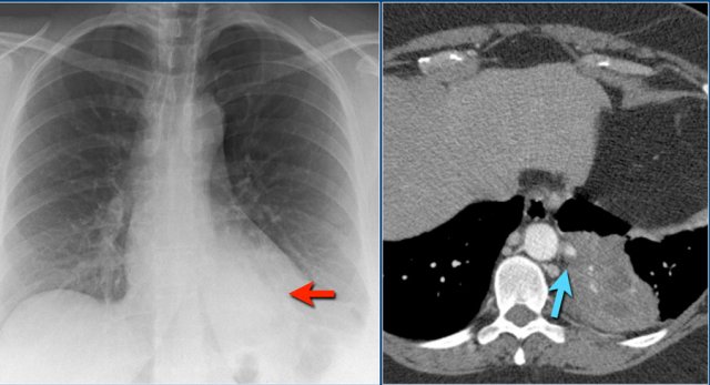 Pulmonary sequestration