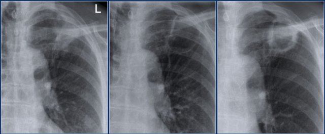 Cavitation in pulmonary embolism