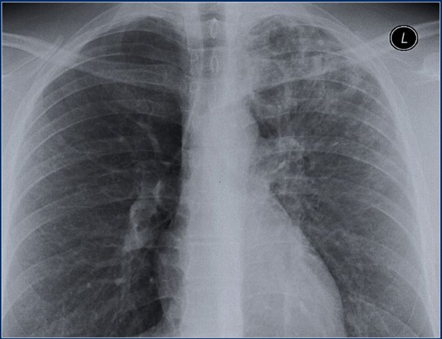 Postprimary TB with cavities