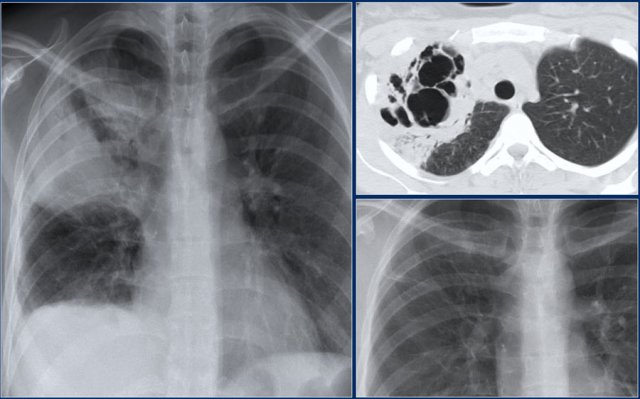 Pneumonia with cavitation. Minimal changes at follow up.