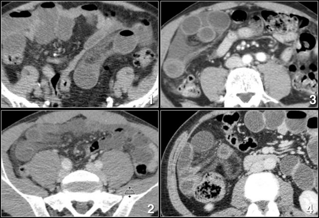 Mesenteric edema