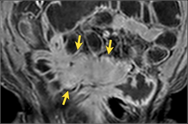 Post-contrast T1 image of a patient with a large infiltrate involving multiple small bowel loops.