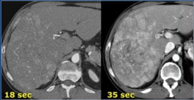 Hypervascular lesion is best seen in late arterial phase.