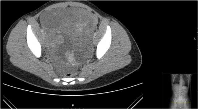 Malignant teratoma