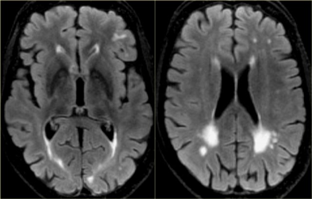 Cerebral Amyloid Angiopathy