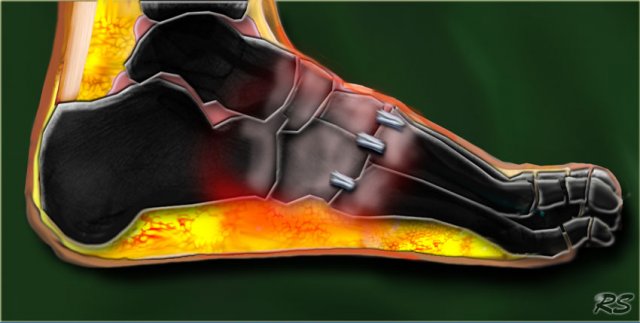 Acute Charcot neuro-osteoarthropathy of the midfoot