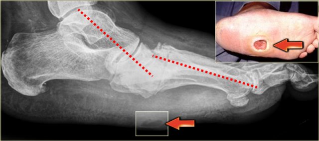 Charcot foot with rocker-bottom deformity and ulceration beneath the bony protuberance of the cuboid