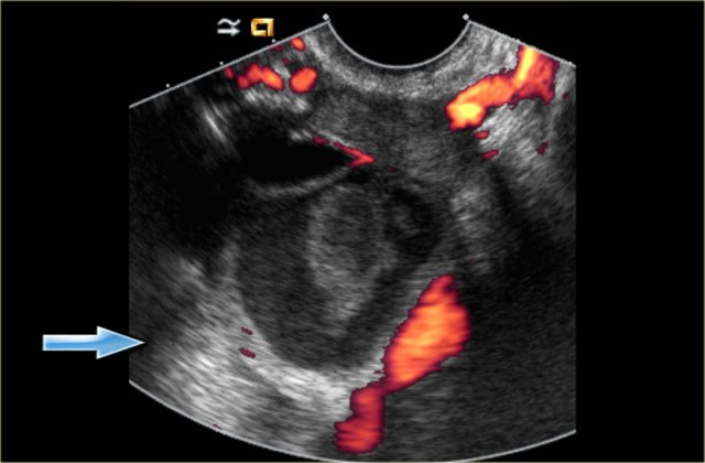 Hemorrhagic cyst with a clot mimicking a neoplasm. Notice absence of flow and good through-transmission (arrow)