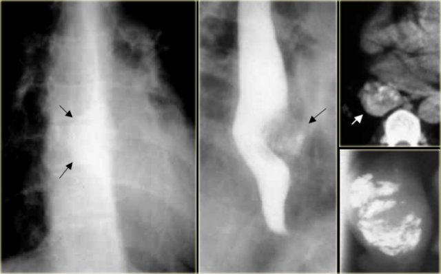 Calcified esophageal leiomyoma