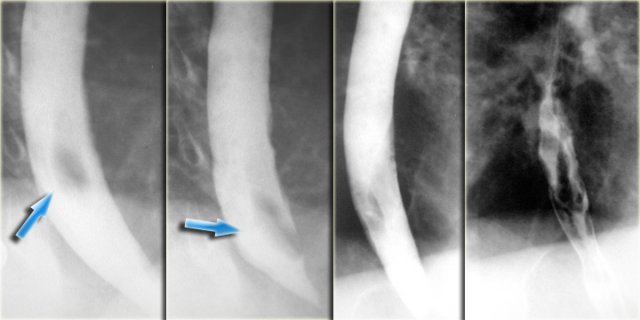 Pedunculated fibrovascular polyps