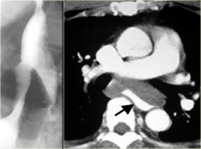 Leiomyosarcoma of the esophagus