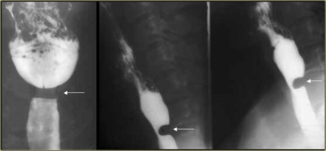 Cricopharyngeal achalasia in 46-year-old woman. Feeling of lump in throat. Persistent indentation (arrow) by cricopharyngeus muscle that does not relax as bolus progresses caudally