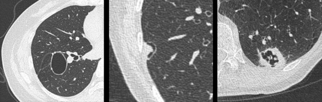 Mimickers of cystic lung cancer: Persistent loculated air space - left panel, rheumatoid nodule - middle panel and a scar - right panel.