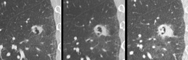 Cystic lung cancer with increase of the solid component over a 2-year scan interval.