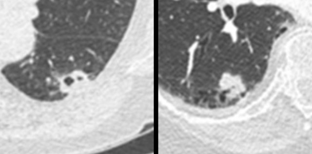 Cystic squamous cell carcinoma.