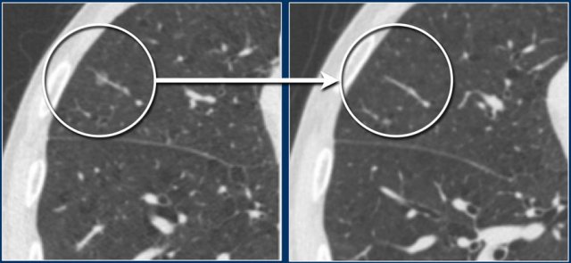 Transient subsolid nodule