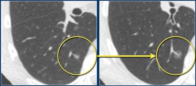 Persistent malignant subsolid nodule