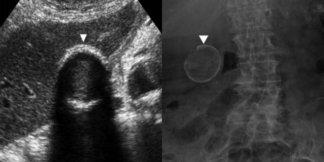 Porcelain gallbladder.