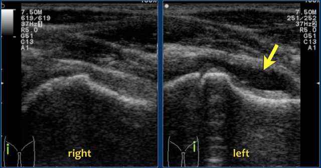 Transient synovitis. The left hip shows a joint effusion (arrow) in the anterior recess which causes separation of the layers of the capsule which are now easily recognized