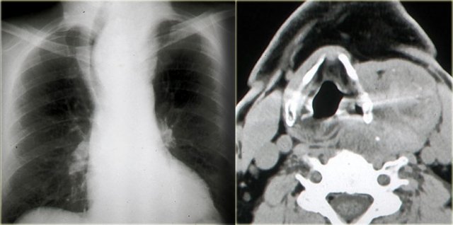 Multinodular goiter with intrathoracic extention