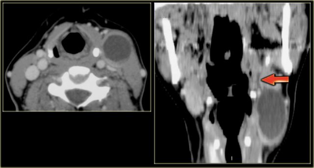 Second branchial cleft cyst: small fistula tract (arrow)