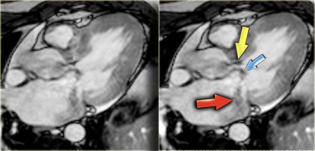 HCM with narrow left ventricular outflow tract (yellow arrow), systolic anterior motion of anterior leaflet of mitral valve (blue arrow) and mitral regurgitation (red arrow)