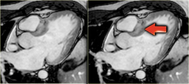 HOCM with hypertrophic basal septum.