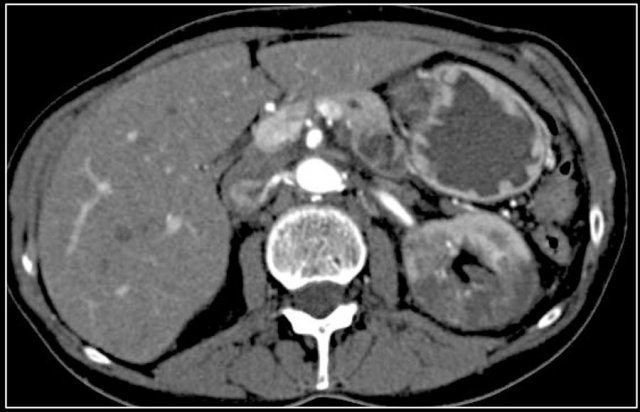 Renal infarction