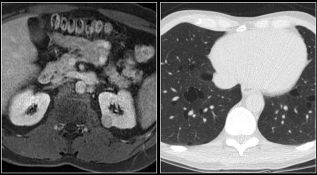 Chromophobe RCC and luncysts in a patient with Birt-Hogg-Dubé syndrome