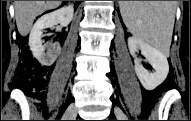 TCC in right kidney preserving the bean shape of the kidney