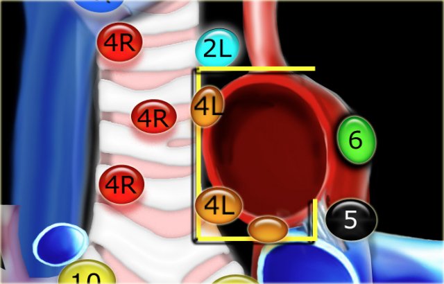 4L. Lower paratracheal nodes