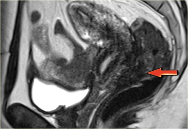 Endometriosis in the  posterior cul-de-sac with infiltration of the rectal wall